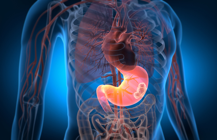 Solid Tumor CAR-T Therapy Approved in China, a World First